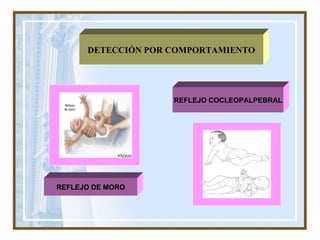 DETECCIÓN POR COMPORTAMIENTO REFLEJO DE MORO REFLEJO COCLEOPALPEBRAL 