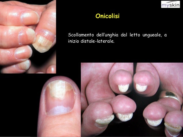 Differenze di dermatite allergica da dermatite atopic
