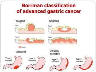 Boreman Classification Bài giảng bệnh học giải phẫu bệnh ung thư dạ dày | PPTX