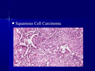  Squamous Cell Carcinoma
 