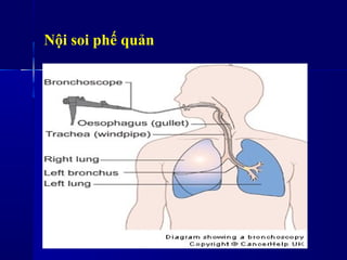 Nội soi phế ản
 