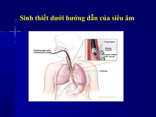 Sinh thiết dưới hướng dẫn của siêu âm
 
