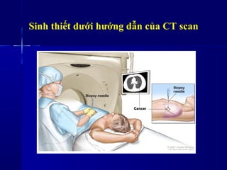 Sinh thiết dưới hướng dẫn của CT scan
 
