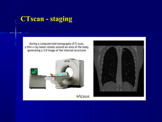 CTscan - staging
 