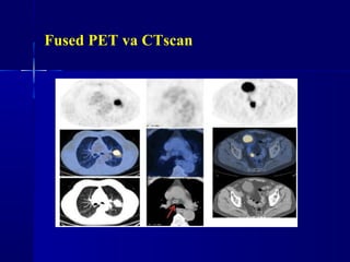 Fused PET va CTscan
 