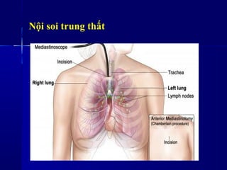 Nội soi trung ٳất
 