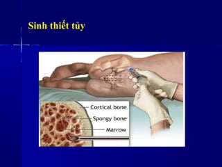 Sinh thiết tủy
 