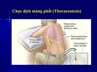 Chọc dịch màng phổi (Thoracentesis)
 