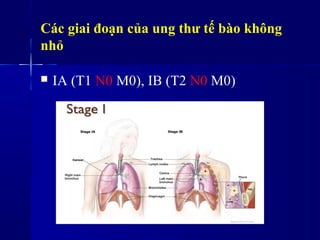 Các giai đoạn của ung thư tế bào không
nhỏ
 IA (T1 N0 M0), IB (T2 N0 M0)
 