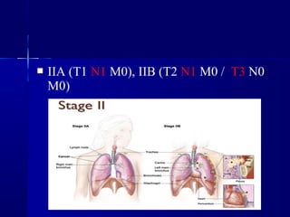  IIA (T1 N1 M0), IIB (T2 N1 M0 / T3 N0
M0)
 
