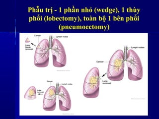 Phẫu trị - 1 phần nhỏ (wedge), 1 thùy
phổi (lobectomy), toàn bộ 1 bên phổi
(pneumoectomy)
 
