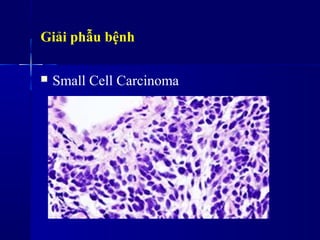 Giải phẫu bệnh
 Small Cell Carcinoma
 