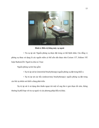 15

Hình 6. Điều trị bằng máy xạ ngoài
+ Tia xạ áp sát: Nguồn phóng xạ được đặt trong cơ thể bệnh nhân. Các đồng vị
phóng xạ được sử dụng là các nguồn mềm có thể uốn nắn được như Cesium 137, Iridium 192
hoặc Radium226. Nguời ta chia ra 2 loại:
Nguồn phóng xạ kín bao gồm:
+ Xạ trị áp sát kẻ (interstitial brachytherapy) nguồn phóng xạ đặt trong khối u
+ Xạ trị áp sát các hốc (endocavitary brachytherapy): nguồn phóng xạ đặt trong
các hốc tự nhiên nơi khối u đang phát triển.
Xạ trị áp sát ít sử dụng đơn thuần ngoại trừ một số ung thư ở giai đoạn rất sớm, thông
thường là phối hợp với tia xạ ngoài và các phương pháp điều trị khác.

 