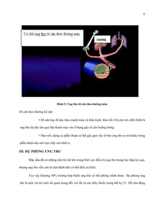 6

Hình 5: Ung thƣ di căn theo đƣờng máu

Di căn theo đường kế cận:
+ Di căn hay đi dọc theo mạch máu và thần kinh, theo lối ít bị cản trở, điển hình là
ung thư dạ dày lan qua lớp thanh mạc vào ổ bụng gây di căn buồng trứng.
+ Dao mổ, dụng cụ phẫu thuật có thể gây gieo rắc tế bào ung thư ra nơi khác trong
phẫu thuật nếu mổ trực tiếp vào khối u.

III. DỰ PHÒNG UNG THƢ
Mặc dầu đã có những tiến bộ rất lớn trong lĩnh vực điều trị ung thư trong hai thập kỷ qua,
nhưng ung thư vẫn còn là một bệnh khó có thể điều trị khỏi.
Tuy vậy khoảng 50% trường hợp bệnh ung thư có thể phòng tránh được. Dự phòng ung
thư là một vai trò mới rất quan trọng đối với tất cả các thầy thuốc trong thế kỷ 21. Để chủ động

 