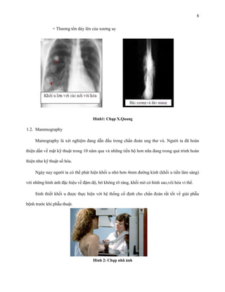8
+ Thương tổn dày lên của xương sọ

Hình1: Chụp X.Quang

1.2. Mammography
Mamography là xét nghiệm đang dẫn đầu trong chẩn đoán ung thư vú. Người ta đã hoàn
thiện dần về mặt kỹ thuật trong 10 năm qua và những tiến bộ hơn nữa đang trong quá trình hoàn
thiện như kỹ thuật số hóa.
Ngày nay người ta có thể phát hiện khối u nhỏ hơn 4mm đường kính (khối u tiền lâm sàng)
với những hình ảnh đặc hiệu về đậm độ, bờ không rõ ràng, khối mờ có hình sao,vôi hóa vi thể.
Sinh thiết khối u được thực hiện với hệ thống cố định cho chẩn đoán rất tốt về giải phẫu
bệnh trước khi phẫu thuật.

Hình 2: Chụp nhũ ảnh

 