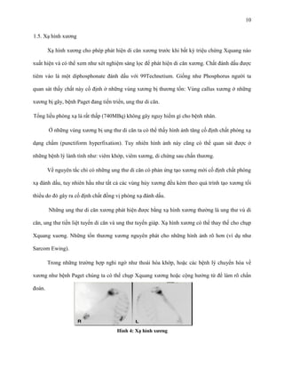 10
1.5. Xạ hình xương
Xạ hình xương cho phép phát hiện di căn xương trước khi bất kỳ triệu chứng Xquang nào
xuất hiện và có thể xem như xét nghiệm sàng lọc để phát hiện di căn xương. Chất đánh dấu được
tiêm vào là một diphosphonate đánh dấu với 99Technetium. Giống như Phosphorus người ta
quan sát thấy chất này cố định ở những vùng xương bị thương tổn: Vùng callus xương ở những
xương bị gãy, bệnh Paget đang tiến triển, ung thư di căn.
Tổng liều phóng xạ là rất thấp (740MBq) không gây nguy hiểm gì cho bệnh nhân.
Ở những vùng xương bị ung thư di căn ta có thể thấy hình ảnh tăng cố định chất phóng xạ
dạng chấm (punctiform hyperfixation). Tuy nhiên hình ảnh này cũng có thể quan sát được ở
những bệnh lý lành tính như: viêm khớp, viêm xương, di chứng sau chấn thương.
Về nguyên tắc chỉ có những ung thư di căn có phản ứng tạo xương mới cố định chất phóng
xạ đánh dấu, tuy nhiên hầu như tất cả các vùng hủy xương đều kèm theo quá trình tạo xương tối
thiểu do đó gây ra cố định chất đồng vị phóng xạ đánh dấu.
Những ung thư di căn xương phát hiện được bằng xạ hình xương thường là ung thư vú di
căn, ung thư tiền liệt tuyến di căn và ung thư tuyến giáp. Xạ hình xương có thể thay thế cho chụp
Xquang xuơng. Những tổn thương xương nguyên phát cho những hình ảnh rõ hơn (ví dụ như
Sarcom Ewing).
Trong những trường hợp nghi ngờ như thoái hóa khớp, hoặc các bệnh lý chuyển hóa về
xương như bệnh Paget chúng ta có thể chụp Xquang xương hoặc cộng hưởng từ để làm rõ chẩn
đoán.

Hình 4: Xạ hình xương

 