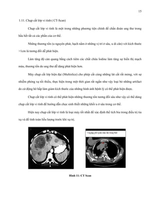 15
1.11. Chụp cắt lớp vi tính ( CT-Scan)
Chụp cắt lớp vi tính là một trong những phương tiện chính để chẩn đoán ung thư trong
hầu hết tất cả các phần của cơ thể.
Những thương tổn (u nguyên phát, hạch nằm ở những vị trí ở sâu, u di căn) với kích thước
>1cm là tương đối dễ phát hiện.
Làm tăng độ cản quang bằng cách tiêm các chất chứa Iodine làm tăng sự hiển thị mạch
máu, thương tổn do ung thư dễ dàng phát hiện hơn.
Máy chụp cắt lớp hiện đại (Multislice) cho phép cắt cùng những lát cắt rất mỏng, với sự
nhiễm phóng xạ tối thiểu, thực hiện trong một thời gian rất ngắn như vậy loại bỏ những artifact
do cử động hô hấp làm giảm kích thước của những hình ảnh bệnh lý có thể phát hiện được.
Chụp cắt lớp vi tính có thể phát hiện những thương tổn tương đối sâu như vậy có thể dùng
chụp cắt lớp vi tính để hướng dẫn chọc sinh thiết những khối u ở sâu trong cơ thể.
Hiện nay chụp cắt lớp vi tính là loại máy tốt nhất để xác định thể tích bia trong điều trị tia
xạ và để tính toán liều lượng trước khi xạ trị.

Hình 11: CT Scan

 