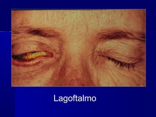Lagoftalmo
 