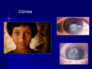 Córnea
 
