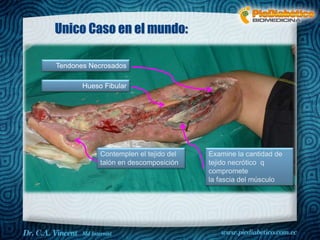Unico Caso en el mundo: 
Tendones Necrosados 
Hueso Fibular 
Examine la cantidad de 
tejido necrótico q 
compromete 
la fascia del músculo 
Contemplen el tejido del 
talón en descomposición 
 