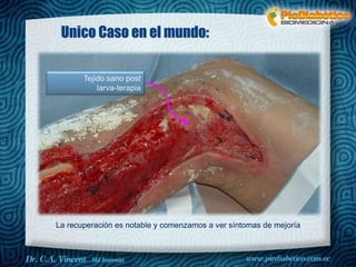 Unico Caso en el mundo: 
Tejido sano post 
larva-terapia 
La recuperación es notable y comenzamos a ver síntomas de mejoría 
 