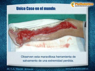 Unico Caso en el mundo: 
Observen esta maravillosa herramienta de 
salvamento de una extremidad perdida. 
