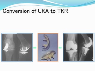 Conversion of UKA to TKR
 