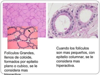 Cuando los folículos
Folículos Grandes,      son mas pequeños, con
llenos de coloide,      epitelio columnar, se le
formados por epitelio   considera mas
plano o cubico, se le   hiperactiva.
considera mas
 
