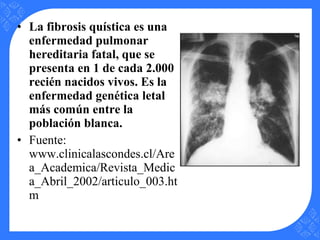 • La fibrosis quística es una
enfermedad pulmonar
hereditaria fatal, que se
presenta en 1 de cada 2.000
recién nacidos vivos. Es la
enfermedad genética letal
más común entre la
población blanca.
• Fuente:
www.clinicalascondes.cl/Are
a_Academica/Revista_Medic
a_Abril_2002/articulo_003.ht
m
 