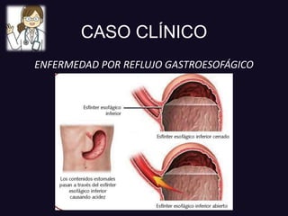 CASO CLÍNICO
ENFERMEDAD POR REFLUJO GASTROESOFÁGICO
 