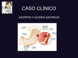 CASO CLÍNICO
GASTRITIS Y ÚLCERAS GASTRICAS
 