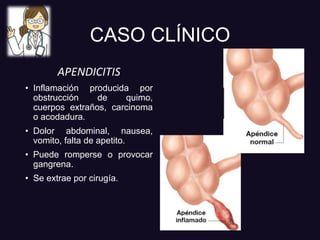 CASO CLÍNICO
APENDICITIS
• Inflamación producida por
obstrucción de quimo,
cuerpos extraños, carcinoma
o acodadura.
• Dolor abdominal, nausea,
vomito, falta de apetito.
• Puede romperse o provocar
gangrena.
• Se extrae por cirugía.
 