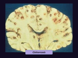 Cisticercosis
 