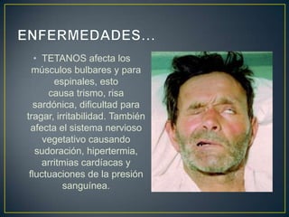 • TETANOS afecta los
músculos bulbares y para
espinales, esto
causa trismo, risa
sardónica, dificultad para
tragar, irritabilidad. También
afecta el sistema nervioso
vegetativo causando
sudoración, hipertermia,
arritmias cardíacas y
fluctuaciones de la presión
sanguínea.
 