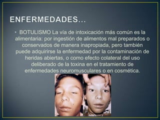 • BOTULISMO La vía de intoxicación más común es la
alimentaria: por ingestión de alimentos mal preparados o
conservados de manera inapropiada, pero también
puede adquirirse la enfermedad por la contaminación de
heridas abiertas, o como efecto colateral del uso
deliberado de la toxina en el tratamiento de
enfermedades neuromusculares o en cosmética.
 