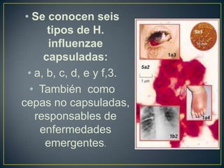 • Se conocen seis
tipos de H.
influenzae
capsuladas:
• a, b, c, d, e y f,3.
• También como
cepas no capsuladas,
responsables de
enfermedades
emergentes.
 