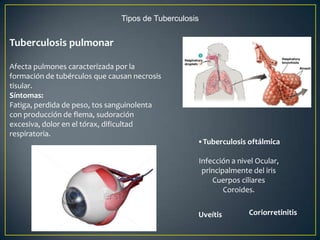 Tipos de Tuberculosis
Tuberculosis pulmonar
Afecta pulmones caracterizada por la
formación de tubérculos que causan necrosis
tisular.
Síntomas:
Fatiga, perdida de peso, tos sanguinolenta
con producción de flema, sudoración
excesiva, dolor en el tórax, dificultad
respiratoria.
•Tuberculosis oftálmica
Infección a nivel Ocular,
principalmente del iris
Cuerpos ciliares
Coroides.
Uveítis Coriorretinitis
 