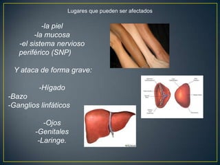 Lugares que pueden ser afectados
-la piel
-la mucosa
-el sistema nervioso
periférico (SNP)
Y ataca de forma grave:
-Hígado
-Bazo
-Ganglios linfáticos
-Ojos
-Genitales
-Laringe.
 