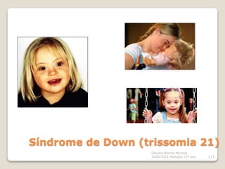 Cláudia Barros Moreira
2020/2021 Biologia 12º ano 215
Síndrome de Down (trissomia 21)
 