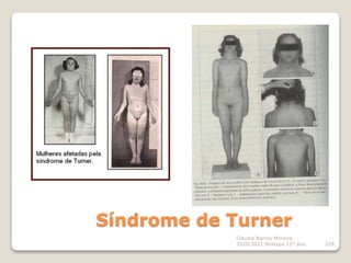 Cláudia Barros Moreira
2020/2021 Biologia 12º ano 228
Síndrome de Turner
 