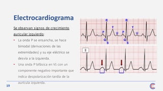 19
Electrocardiograma
Se observan signos de crecimiento
auricular izquierdo:
• La onda P se ensancha, se hace
bimodal (derivaciones de las
extremidades) y su eje eléctrico se
desvía a la izquierda.
• Una onda P bifásica en V1 con un
componente negativo importante que
indica despolarización tardía de la
aurícula izquierda.
 