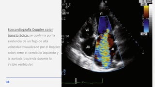 38
Ecocardiografía Doppler color
transtorácica: se confirma por la
existencia de un flujo de alta
velocidad (visualizado por el Doppler
color) entre el ventrículo izquierdo y
la aurícula izquierda durante la
sístole ventricular.
 