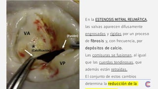 4
En la ESTENOSIS MITRAL REUMÁTICA,
las valvas aparecen difusamente
engrosadas y rígidas por un proceso
de fibrosis y, con frecuencia, por
depós itos de calcio.
Las comisuras se fusionan, al igual
que las cuerdas tendinosas, que
además están retraídas.
El conjunto de estos cambios
determina la reducción de la
(Calcificación)
(Fusión)
 