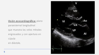 5
Visión ecocardiográfica: plano
paraesternal longitudinal
que muestra los velos mitrales
engrosados y con apertura en
cúpula
en diástole.
 