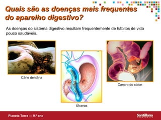 Quais são as doenças mais frequentes
do aparelho digestivo?
As doenças do sistema digestivo resultam frequentemente de hábitos de vida
pouco saudáveis.

Cárie dentária
Cancro do cólon

Úlceras
Planeta Terra — 9.º ano

 