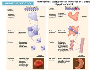 ANEMIA DREPANOCÍTICA
Hemoglobina S: Sustitución de un aminoácido en la cadena
polipeptídica de la Hb
 