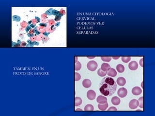 EN UNA CITOLOGIA
CERVICAL
PODEMOS VER
CELULAS
SEPARADAS
TAMBIEN EN UN
FROTIS DE SANGRE
 