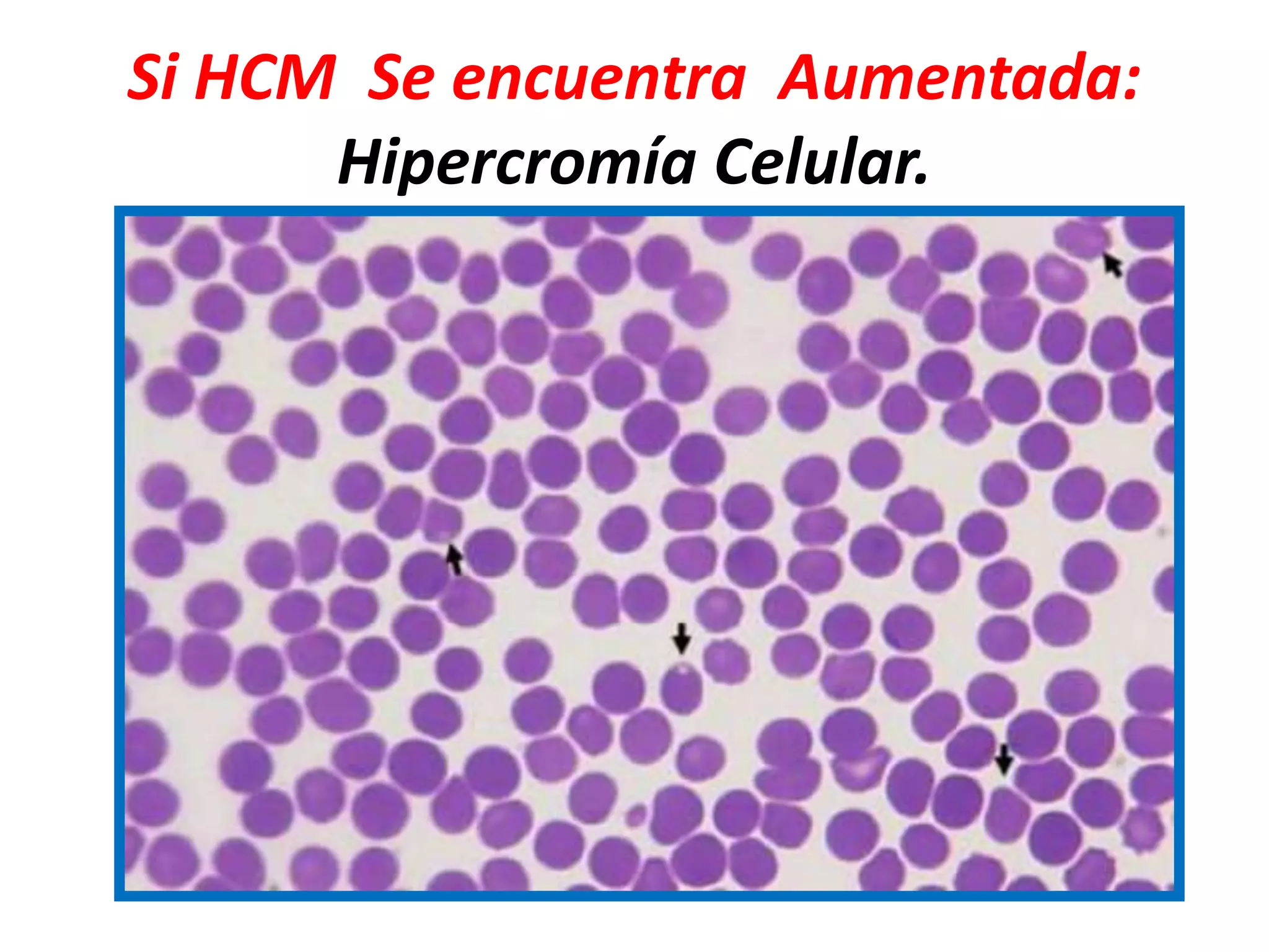 Si HCM Se encuentra Aumentada:
Hipercromía Celular.
 