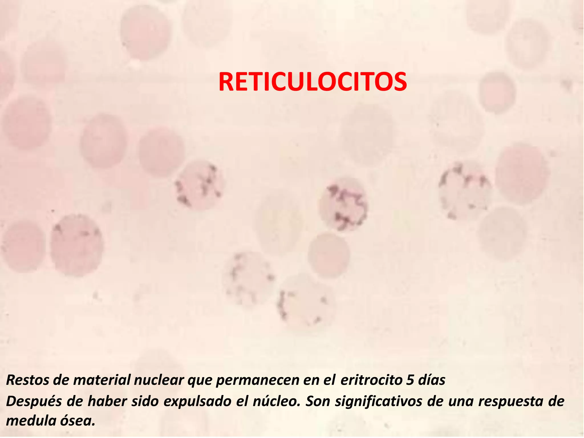 RETICULOCITOS
Restos de material nuclear que permanecen en el eritrocito 5 días
Después de haber sido expulsado el núcleo. Son significativos de una respuesta de
medula ósea.
 