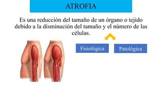 ATROFIA
Es una reducción del tamaño de un órgano o tejido
debido a la disminución del tamaño y el número de las
células.
Fisiológica Patológica
 